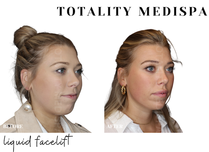 Liquid facelift before and after results at Totality MediSpa Hilton Head
