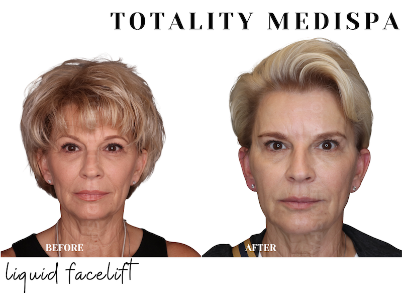 Natural facial filler transformation by Dr. Nicole Nadel