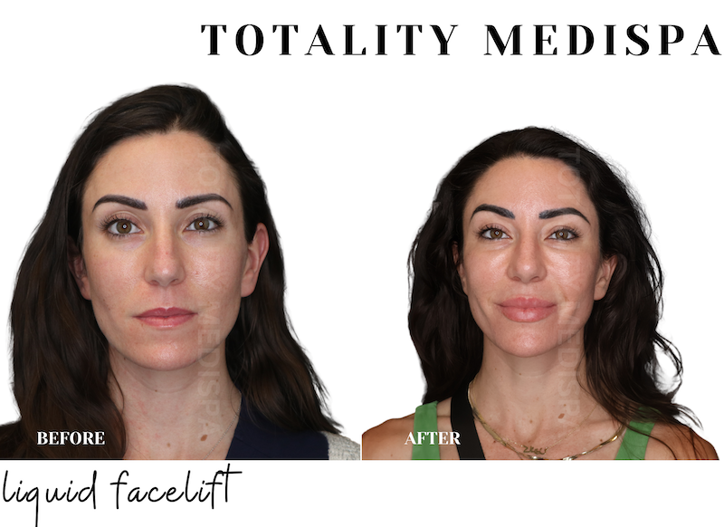 Injectable treatment before and after showing refreshed facial appearance