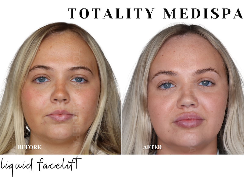 Liquid facelift before and after results
