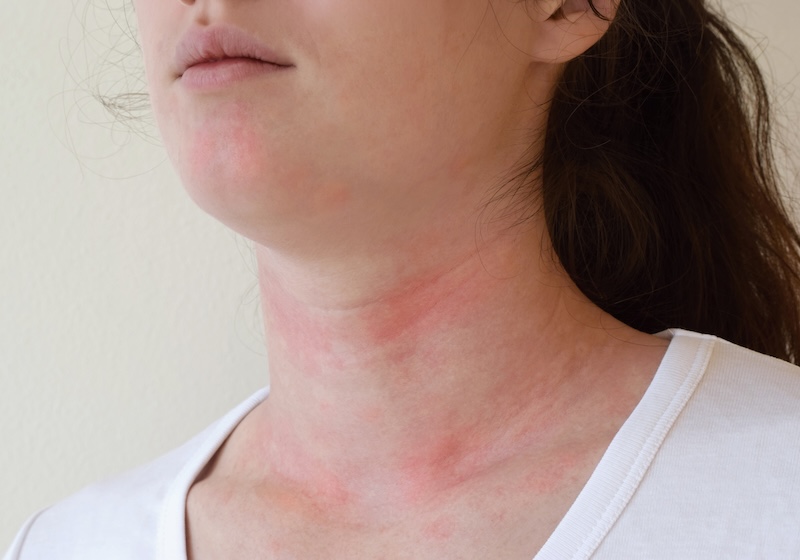 Redness and swelling on a person’s neck illustrating possible symptoms of a shellfish allergic reaction.