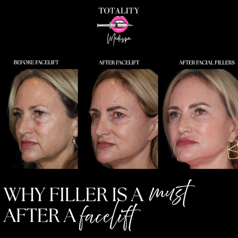 Full face transformation - Totality Medispa Hilton Head