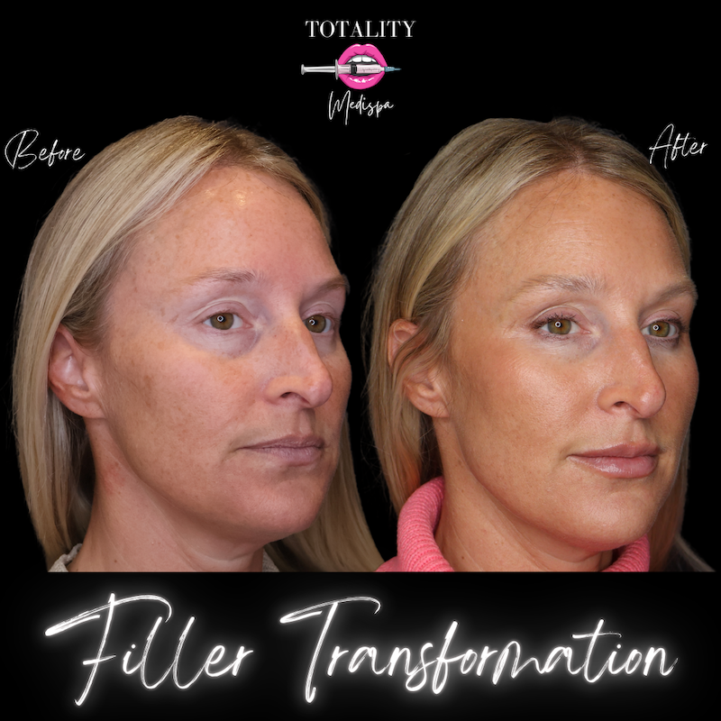 Facial filler before and after at Totality MediSpa Hilton Head