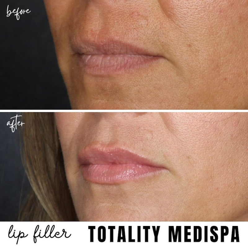 Lip filler before and after at Totality MediSpa Hilton Head