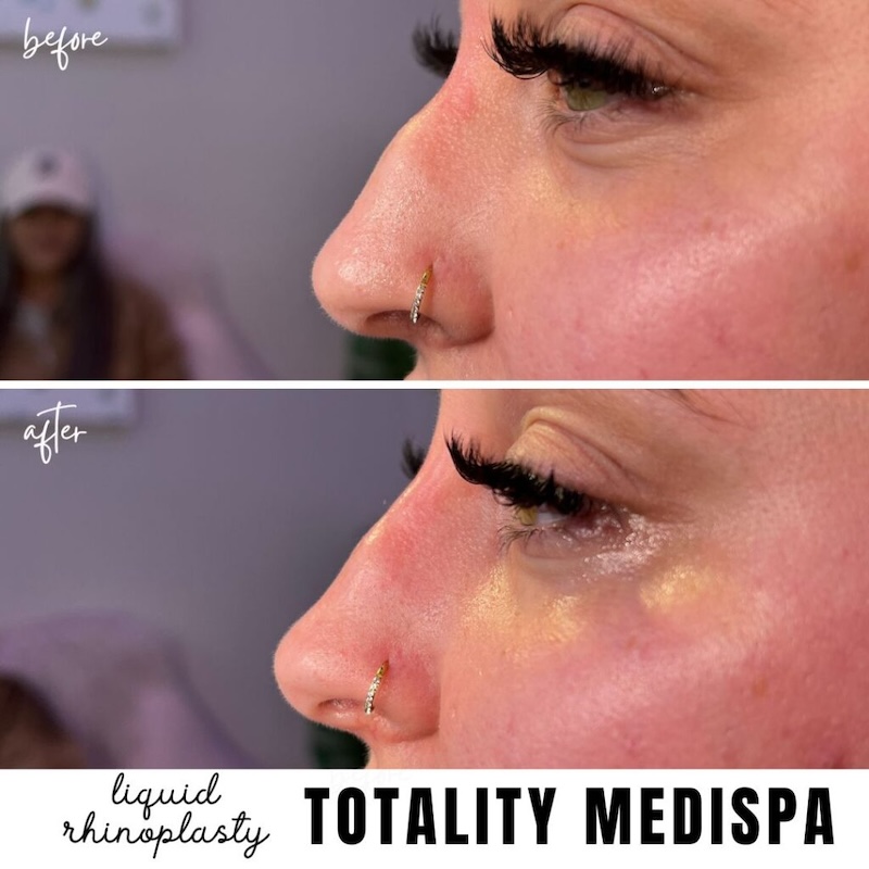 Liquid rhinoplasty before and after at Totality MediSpa Hilton Head