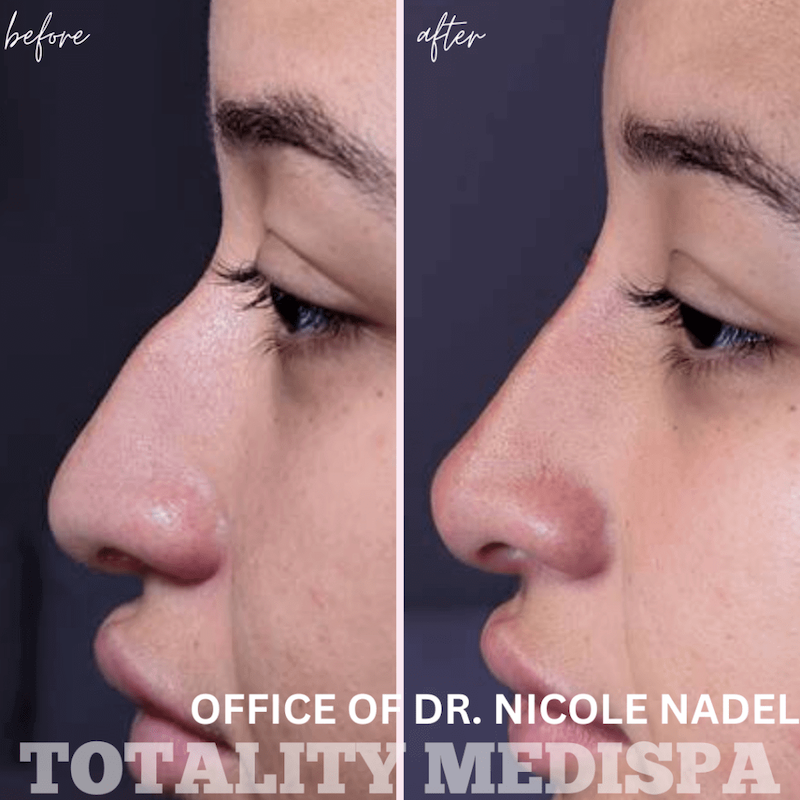 Liquid rhinoplasty - Totality MediSpa Hilton Head